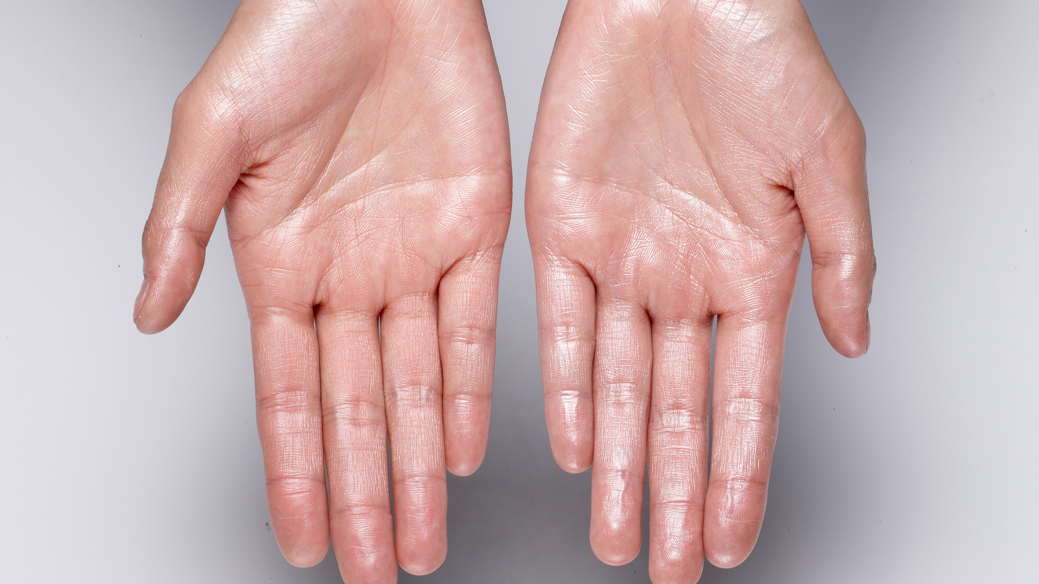 Mani sudate: cause, rimedi efficaci e come prevenirle