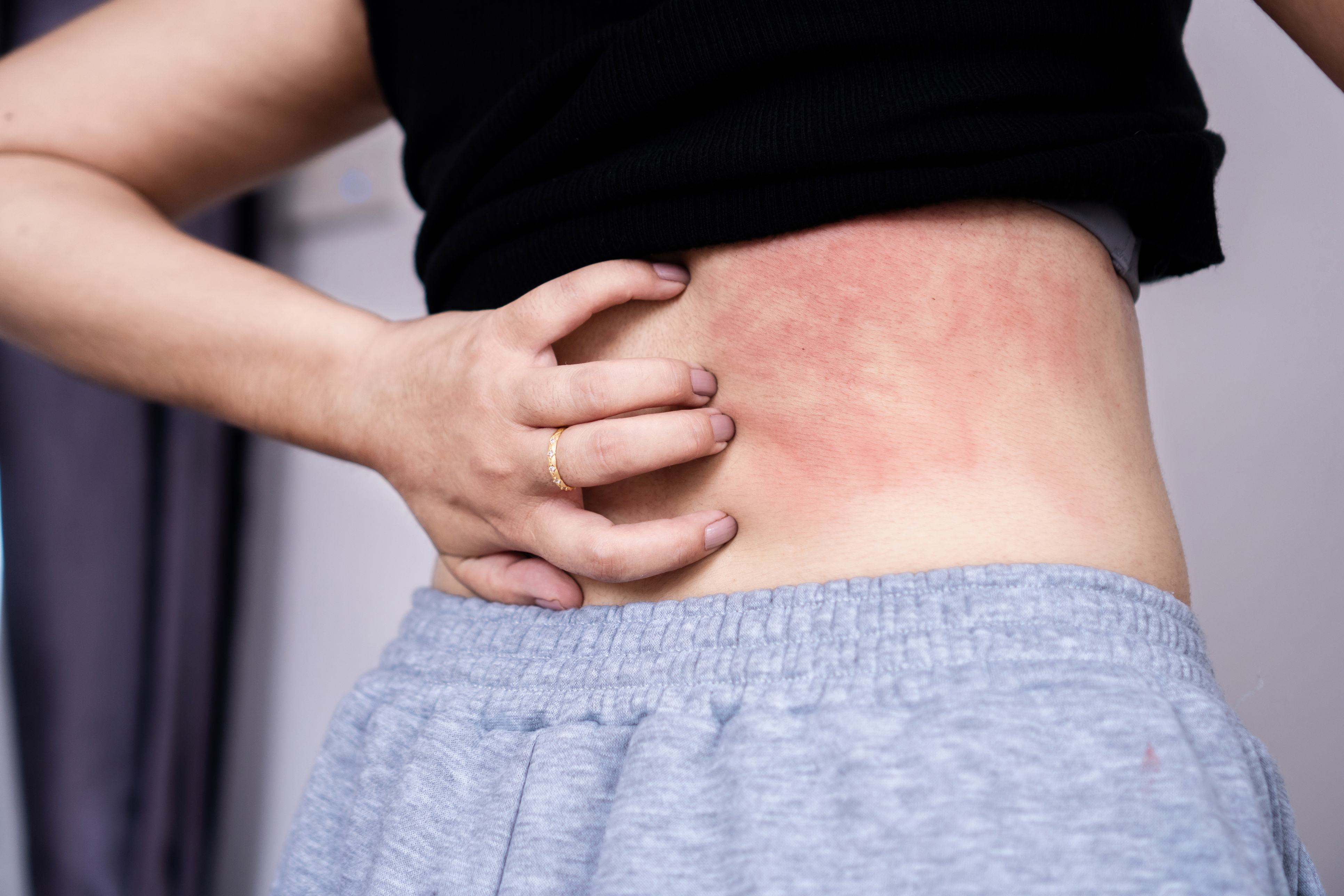 Dermatite da sudore: sintomi, cause e rimedi