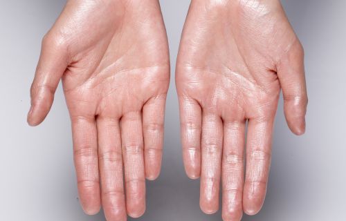 Mani sudate: cause, rimedi efficaci e come prevenirle