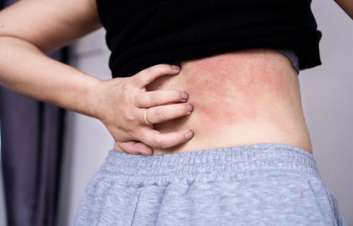 Dermatite da sudore: sintomi, cause e rimedi