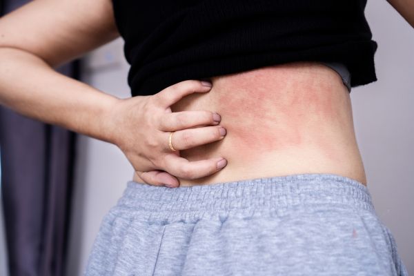 Dermatite da sudore: sintomi, cause e rimedi